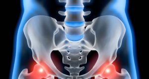 Osteoporosis and Menopause: Protecting Your Bone Health Naturally Osteoporosis and Menopause